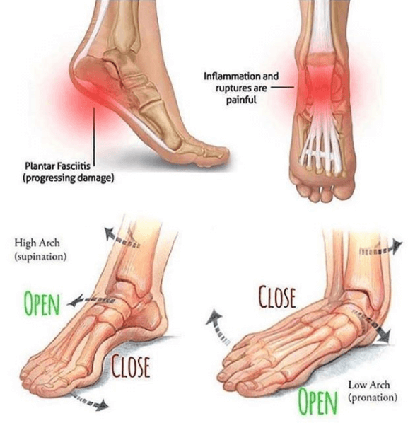 Plantar Fasciitis - Explained ! Foot Pain Advice